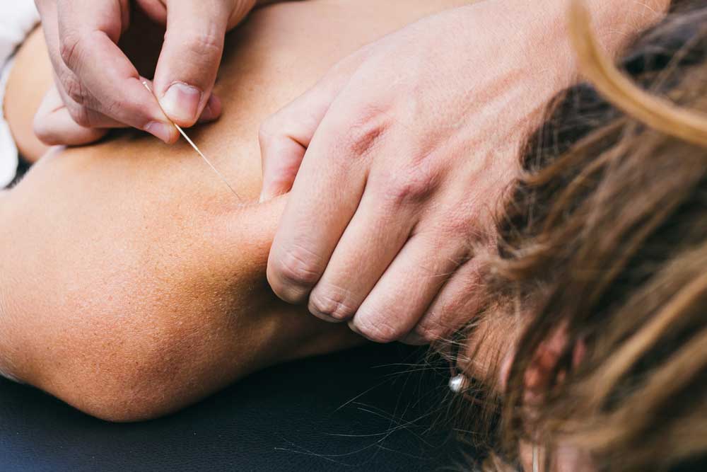 Accupuncture/Dry Needling - Physical Therapies